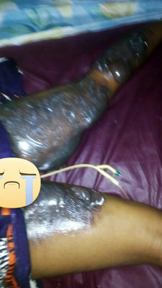 ?The fire started under my buttocks? - Corps member serving in Rivers state gives graphic details + photos of a ghastly accident she recently survived