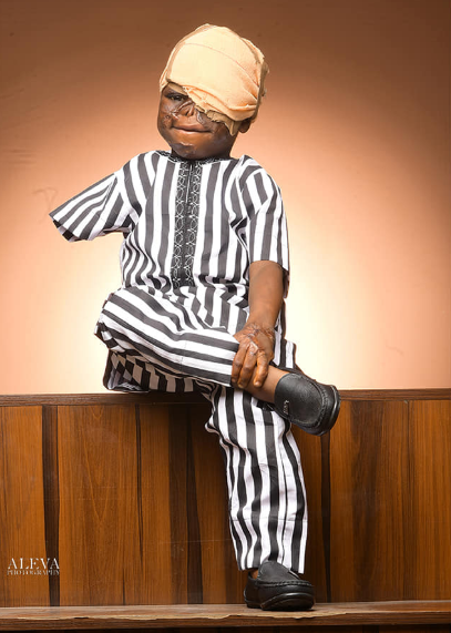 Young burn victim who lost his sight and arm in fire accident defies the odds to survive (photos)