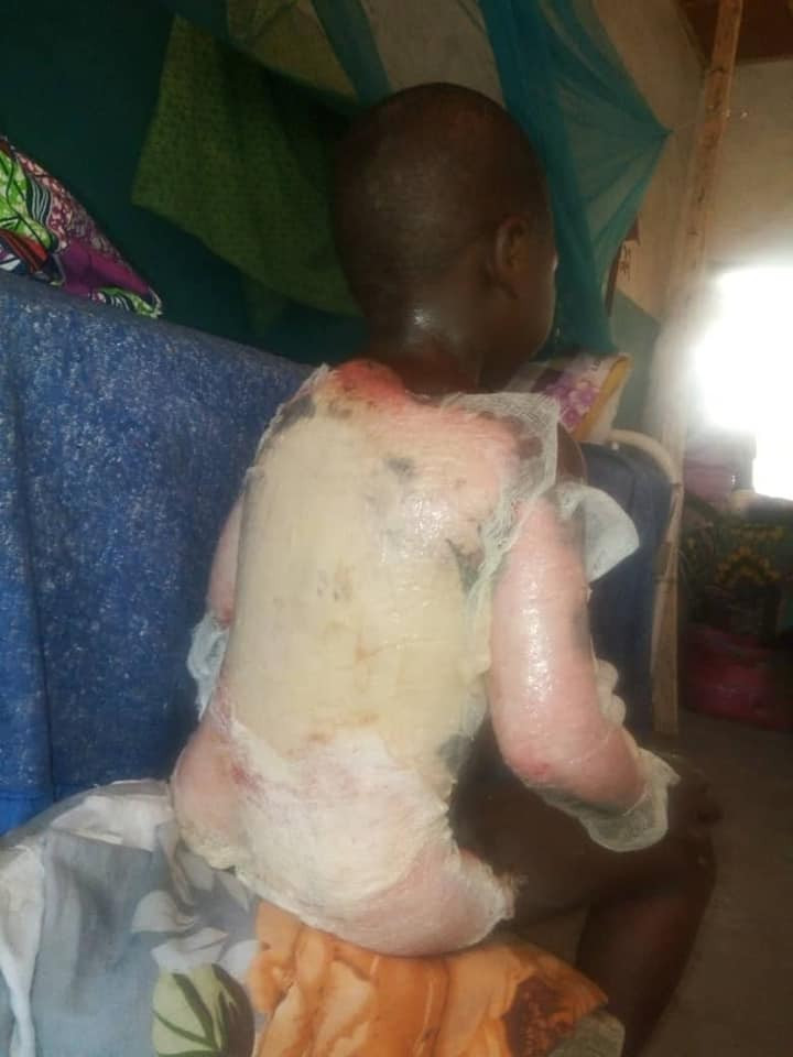 Graphic: Woman scalds body of her step son with hot water in Adamawa state
