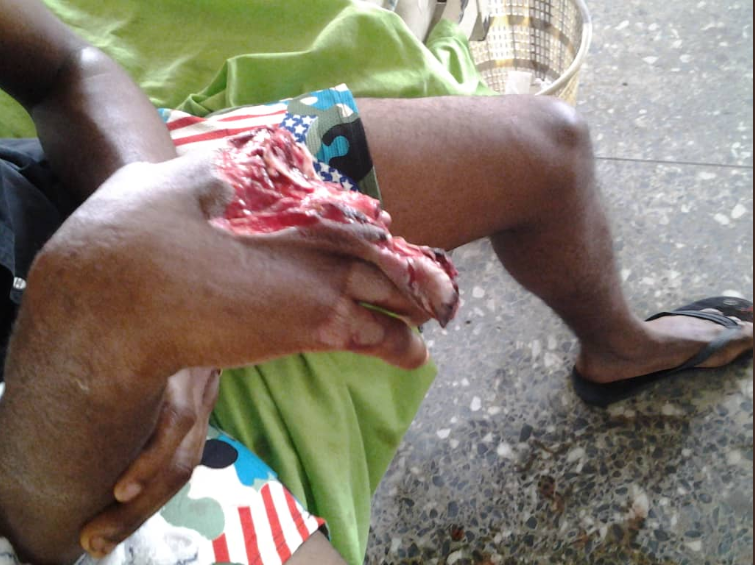 Fireworks blows off fingers of a student of UNIUYO as it exploded while he was still holding it (graphic photos)