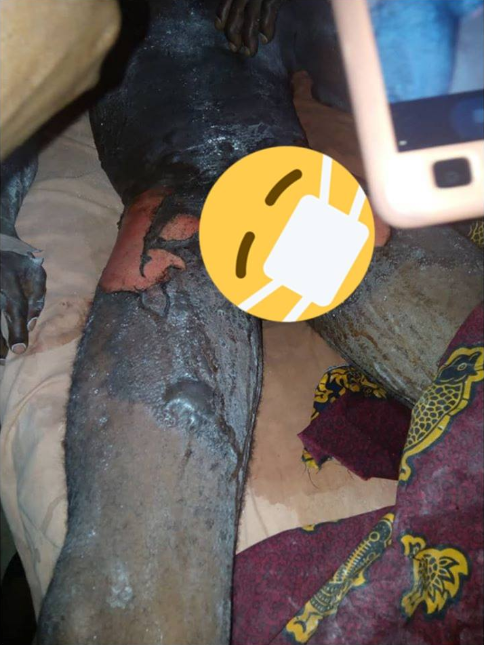 Woman pours boiling water mixed with pepper on her husband (graphic photos)