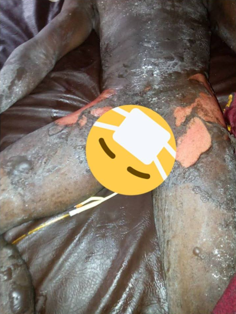 Woman pours boiling water mixed with pepper on her husband (graphic photos)