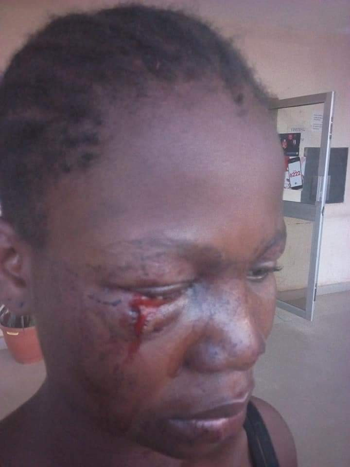 Sad story of a 17-year-old girl who almost lost an eye after she was brutally assaulted by a man in Abuja for turning down his sexual advance