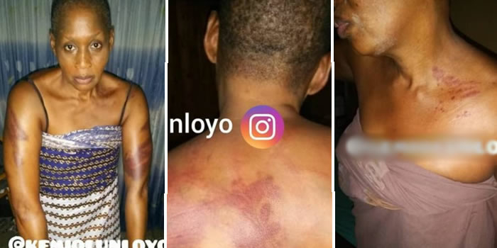 Kemi Olunloyo shows the scars inflicted on her body by Armed robbers