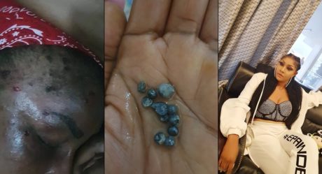 Alleged Assassination Attempt: Angela Okorie shares photo of pellets that were removed from her head