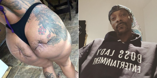 L-R: Lady's butt scarred by cosmetic surgery, Snoop Dogg