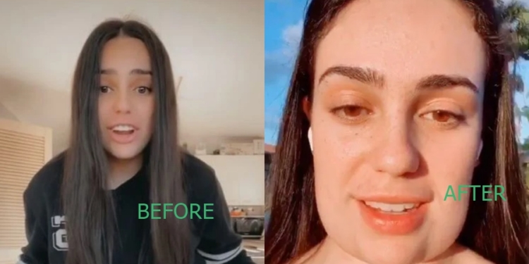Woman "ends up with square head" after botched chin fat removal surgery