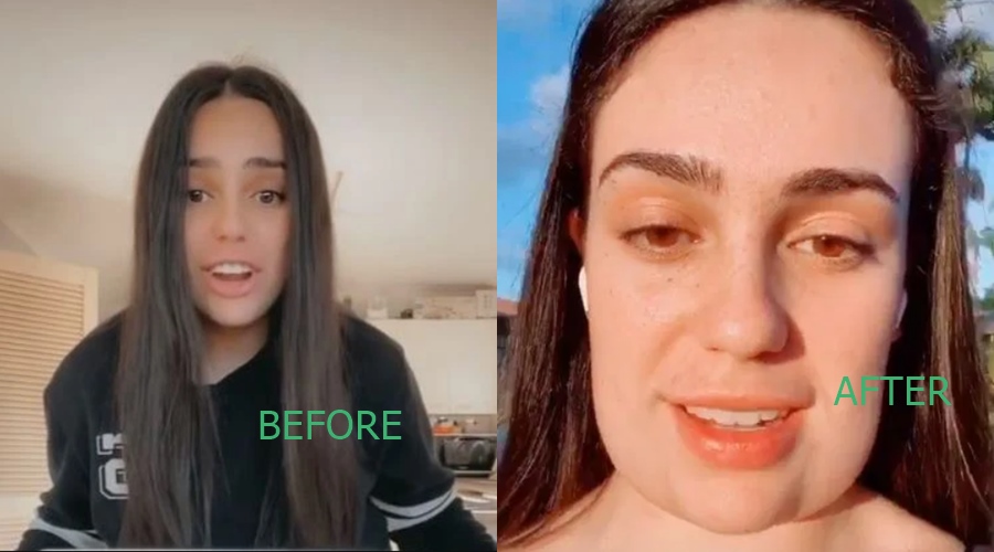 Woman "ends up with square head" after botched chin fat removal surgery