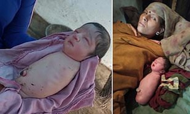 Baby Girl Born With No Arms or Legs Leaves Doctors Baffled