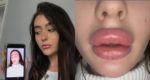 Photos: Lady Left With WEIRDLY SHAPED Lips After Botched Lip Filler Treatment