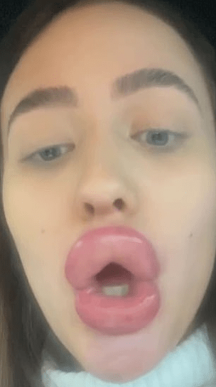 Photos: Lady Left With WEIRDLY SHAPED Lips After Botched Lip Filler Treatment