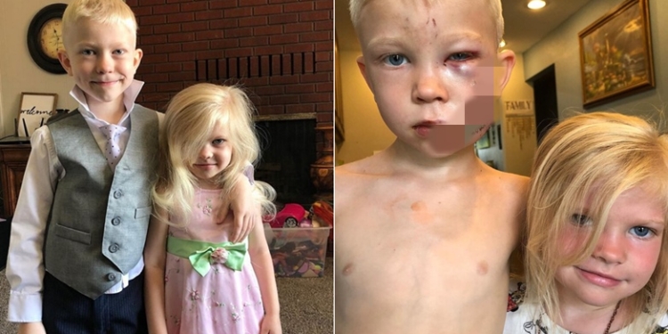 Boy left with 90 stitches after risking own life to save sister from dog attack
