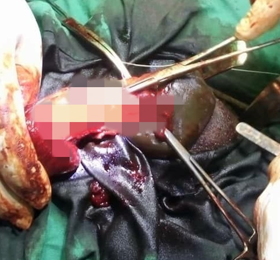 Nigerian man suffers penile fracture while engaging in rigorous sex with his partner (graphic photos)