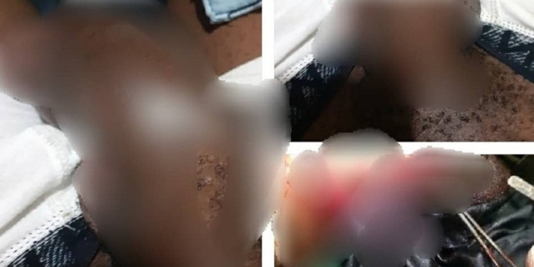 Nigerian man suffers penile fracture while engaging in rigorous sex with his partner (graphic photos)