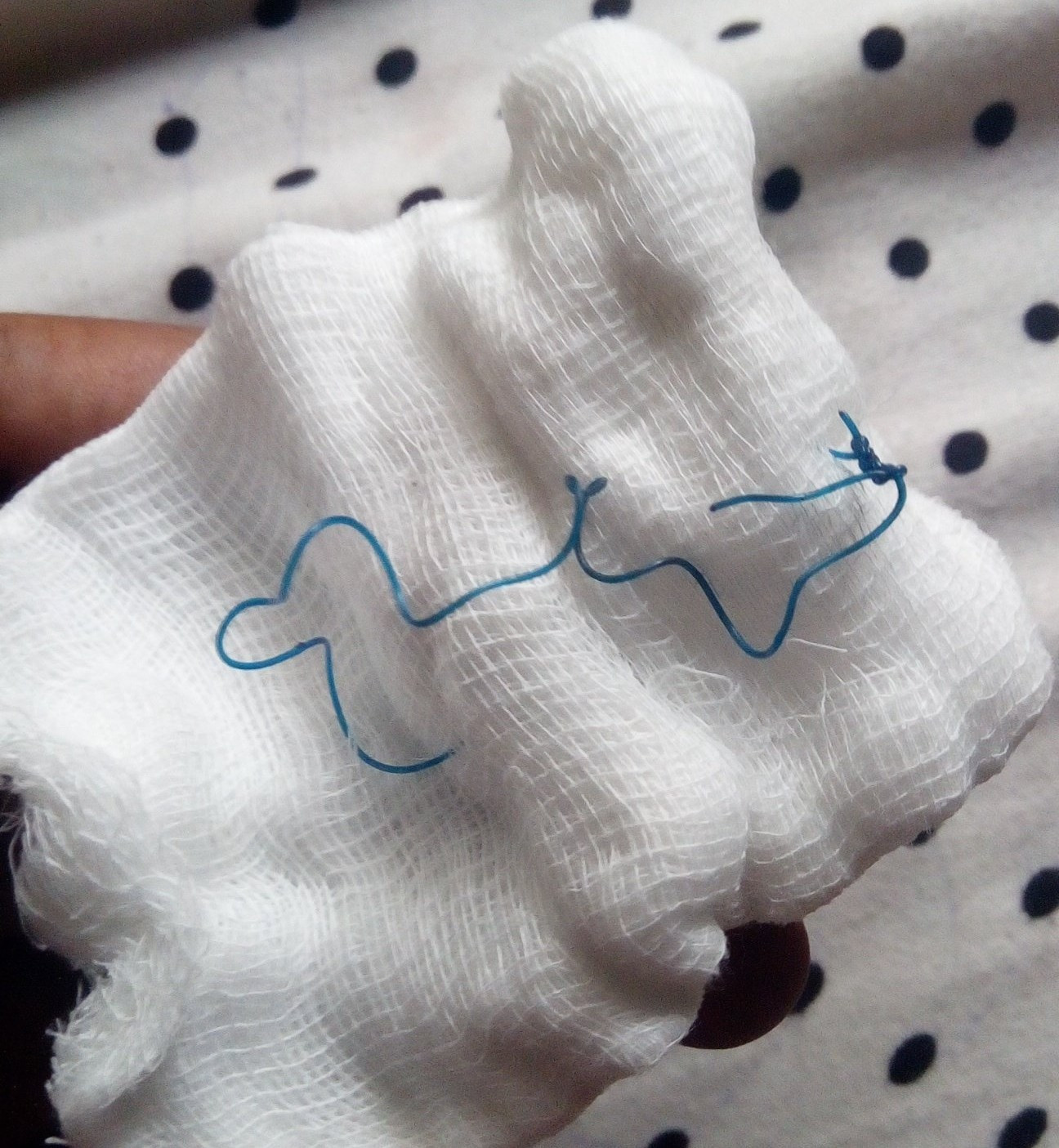 New mum whose stitches refused to heal months after delivery reveals what was found in her body after surgery