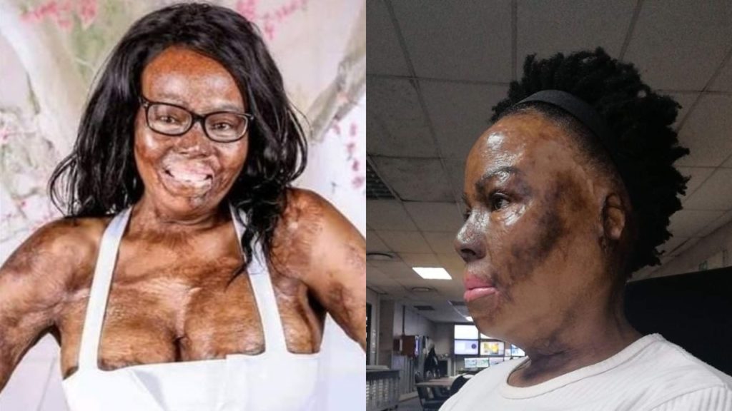 South African lady narrates how her husband poured petrol and set her ablaze during an argument