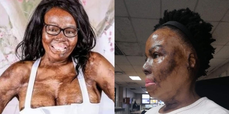 South African lady narrates how her husband poured petrol and set her ablaze during an argument