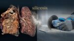 silicosis