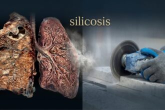 silicosis