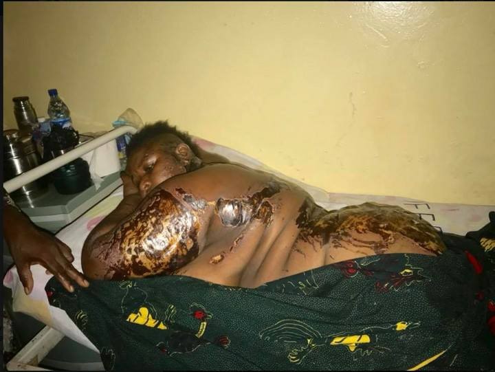 Graphic Photos:?Plus-Size woman bathed with acid by her younger ex-lover in Anambra State