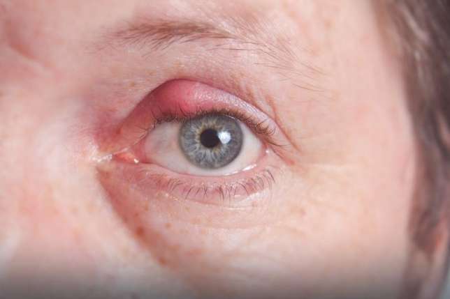 5 home remedies to help you get rid of boils