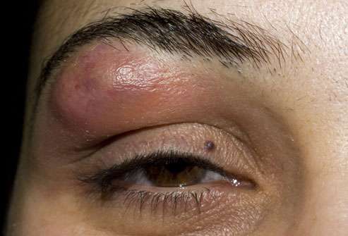 5 home remedies to help you get rid of boils